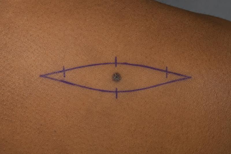 The excision planned on the skin before the first incision