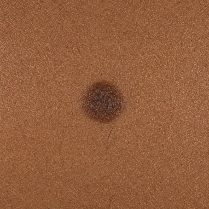 Lesion and oncologic