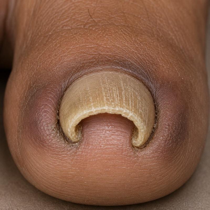 Structural and nail