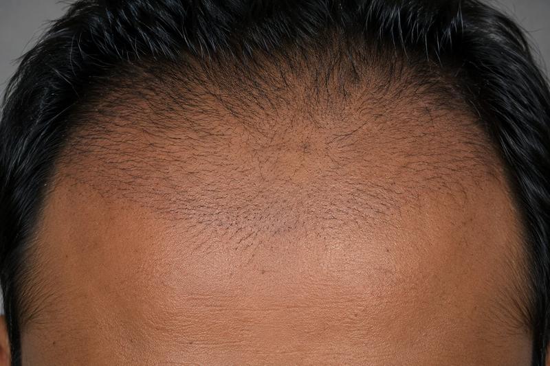 Month three. The phase most clinics never show you