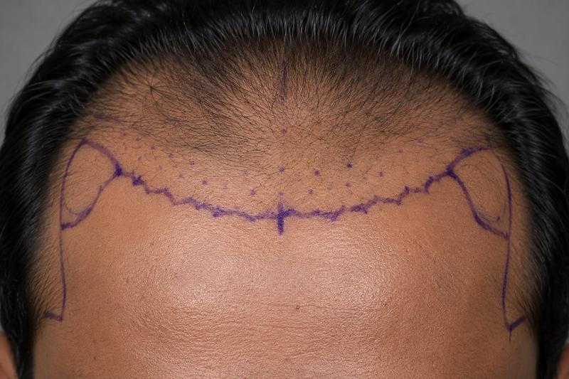 A hairline drawn by the surgeon, before anything else happens
