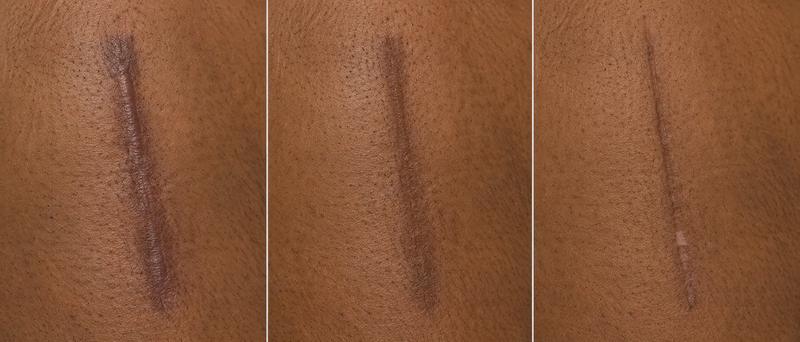 The same scar at week six, month three and month twelve