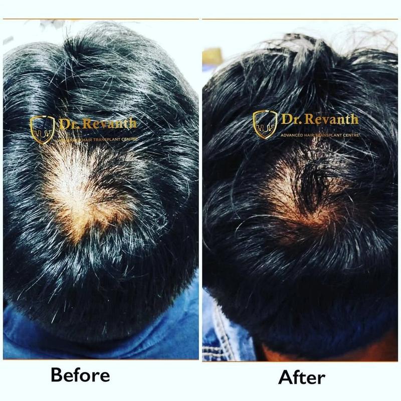 Hair transplant result documented by Dr. Revanth's Hair Clinic