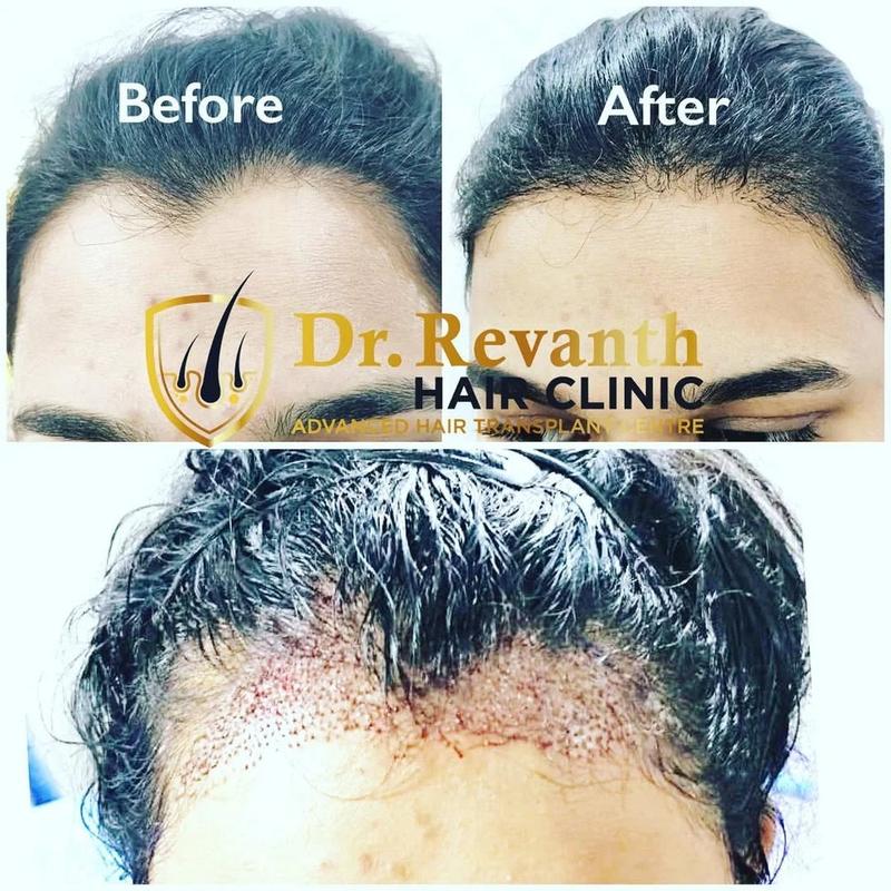 Hair transplant result documented by Dr. Revanth's Hair Clinic