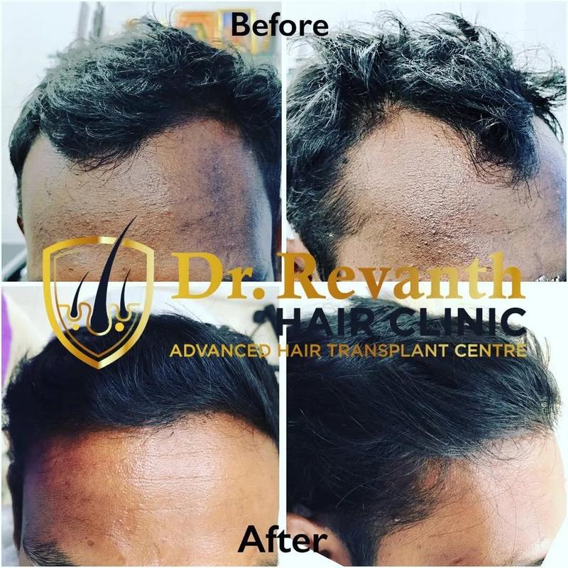 Hair transplant result documented by Dr. Revanth's Hair Clinic