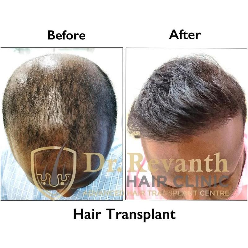 Hair transplant result documented by Dr. Revanth's Hair Clinic