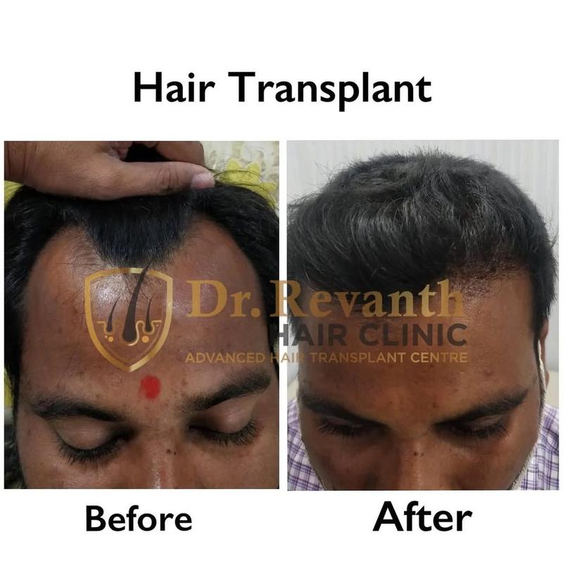 Hair transplant result documented by Dr. Revanth's Hair Clinic
