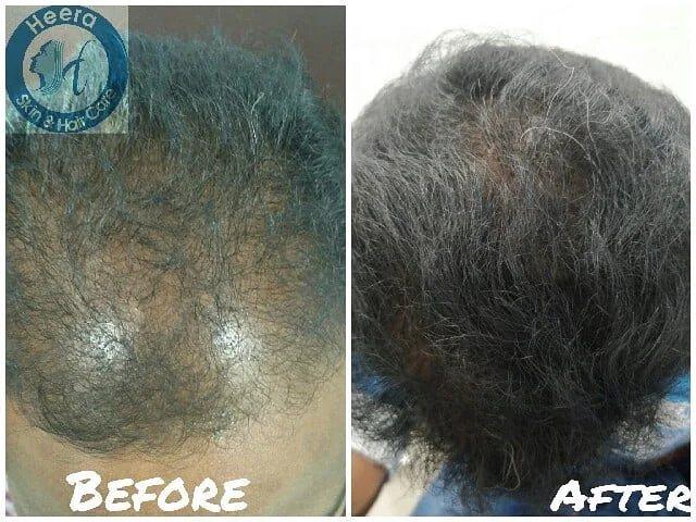 Hair transplant result documented by Dr. Revanth's Hair Clinic