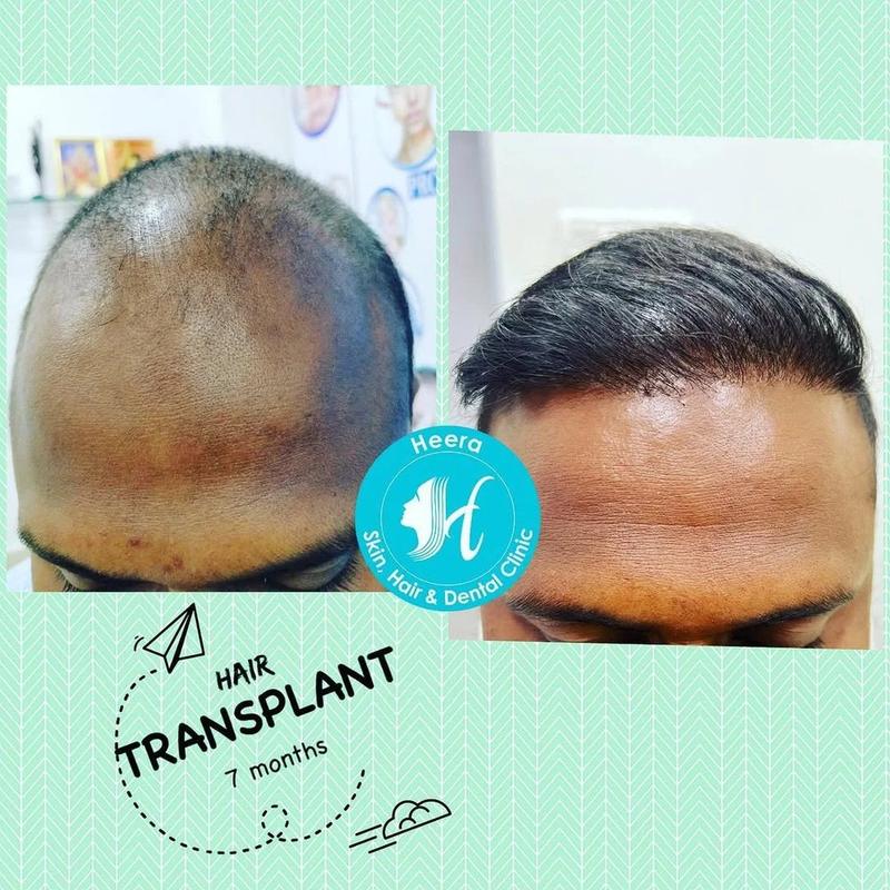 Hair transplant result documented by Dr. Revanth's Hair Clinic