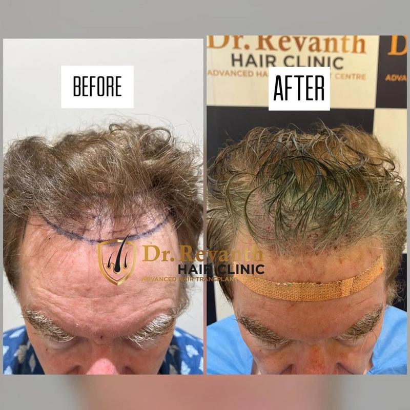 Hair transplant result documented by Dr. Revanth's Hair Clinic