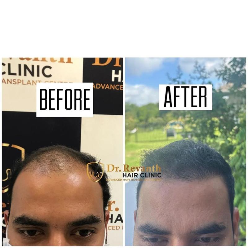 Hair transplant result documented by Dr. Revanth's Hair Clinic
