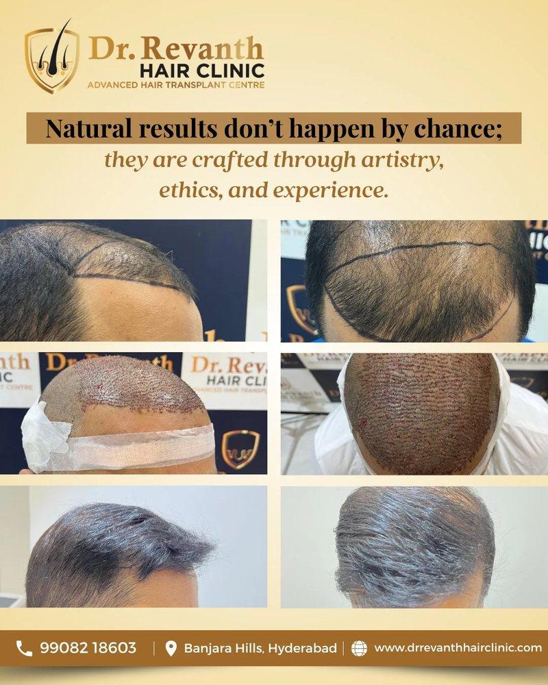 Hair transplant result documented by Dr. Revanth's Hair Clinic