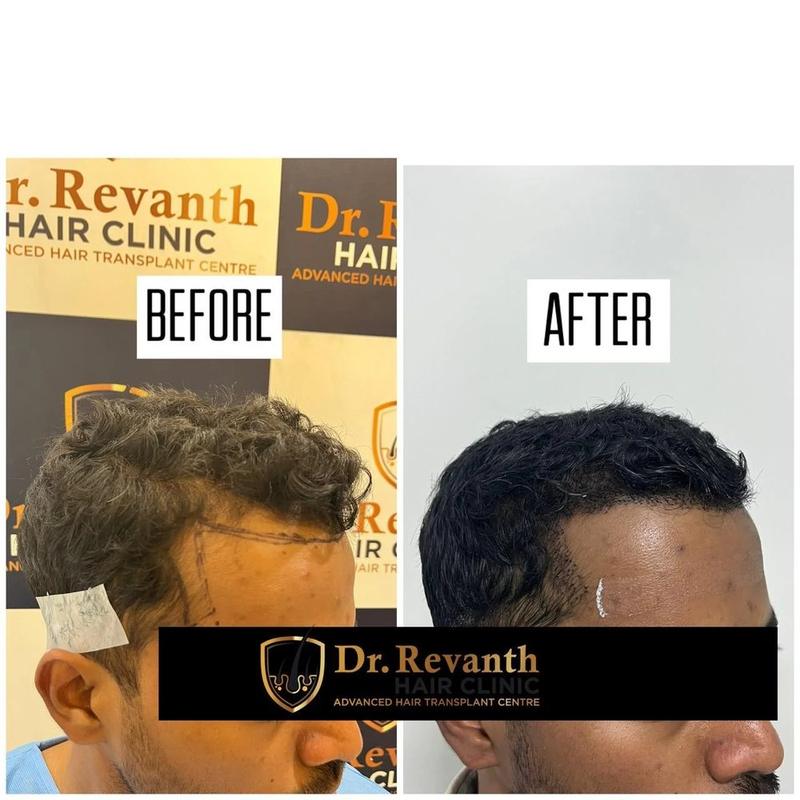 Hair transplant result documented by Dr. Revanth's Hair Clinic