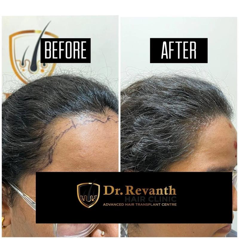 Hair transplant result documented by Dr. Revanth's Hair Clinic