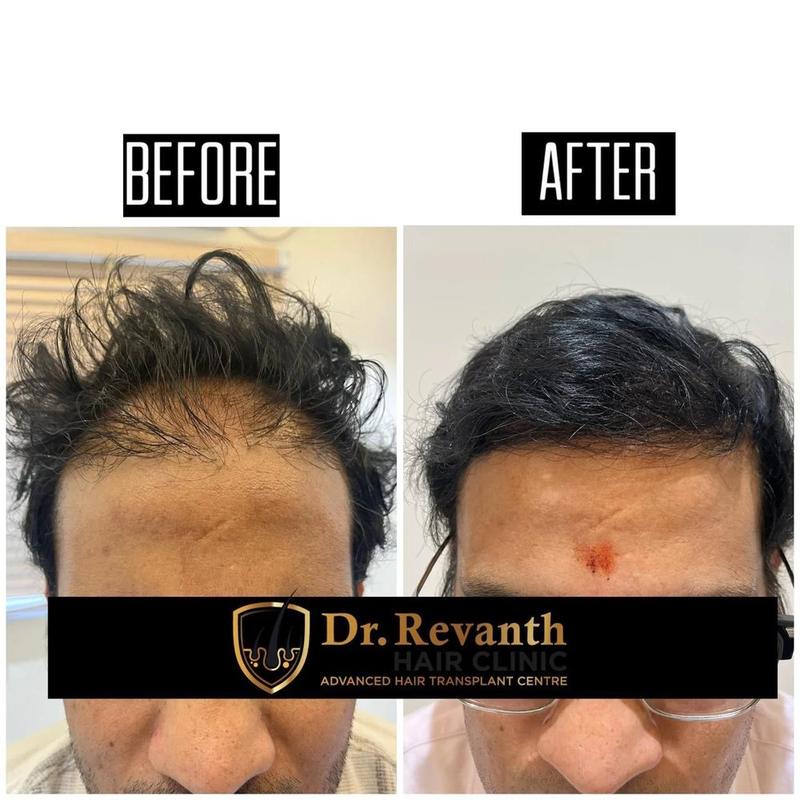 Hair transplant result documented by Dr. Revanth's Hair Clinic