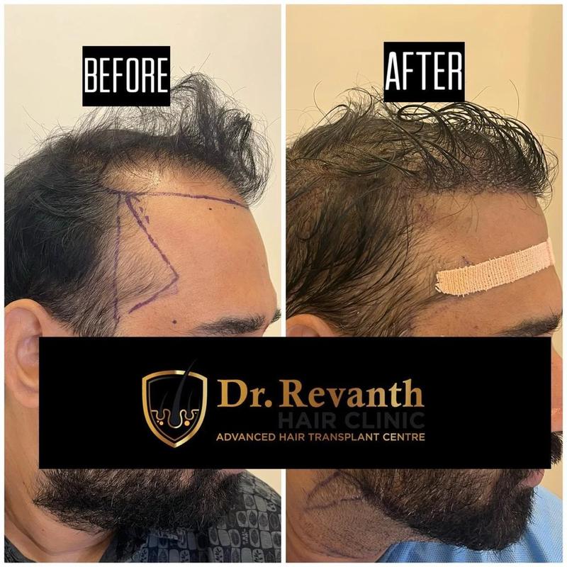 Hair transplant result documented by Dr. Revanth's Hair Clinic